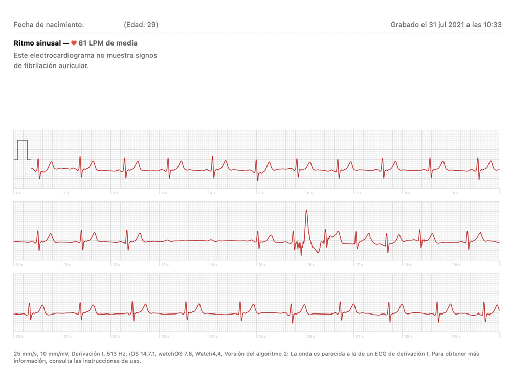 Y así fue como descubrió su problema cardíaco. Fuente: Applesfera (https://www.applesfera.com/apple-watch/salvado-apple-watch-usuario-espanol-detecta-bloqueo-cardiaco-gracias-a-su-reloj)